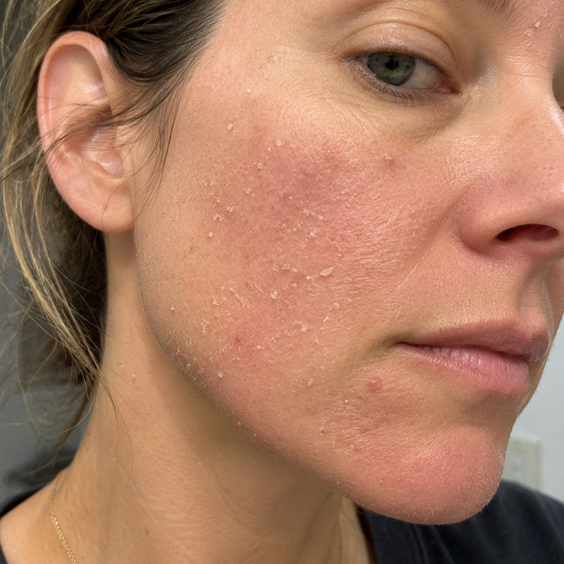 Retinol irritation vs gentle serum